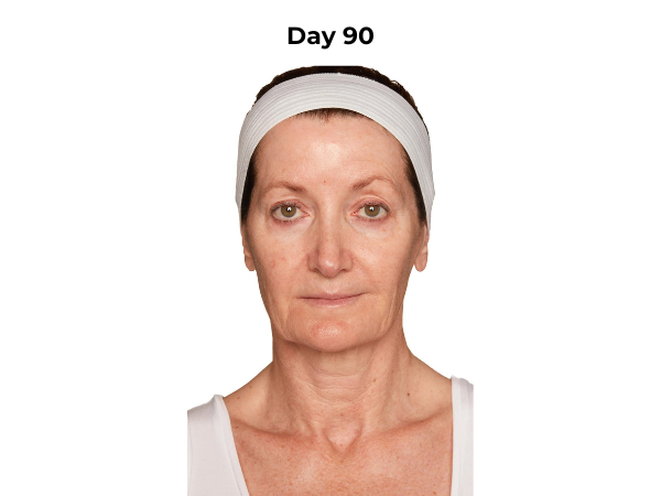 Mona day 90 photo (frontal)